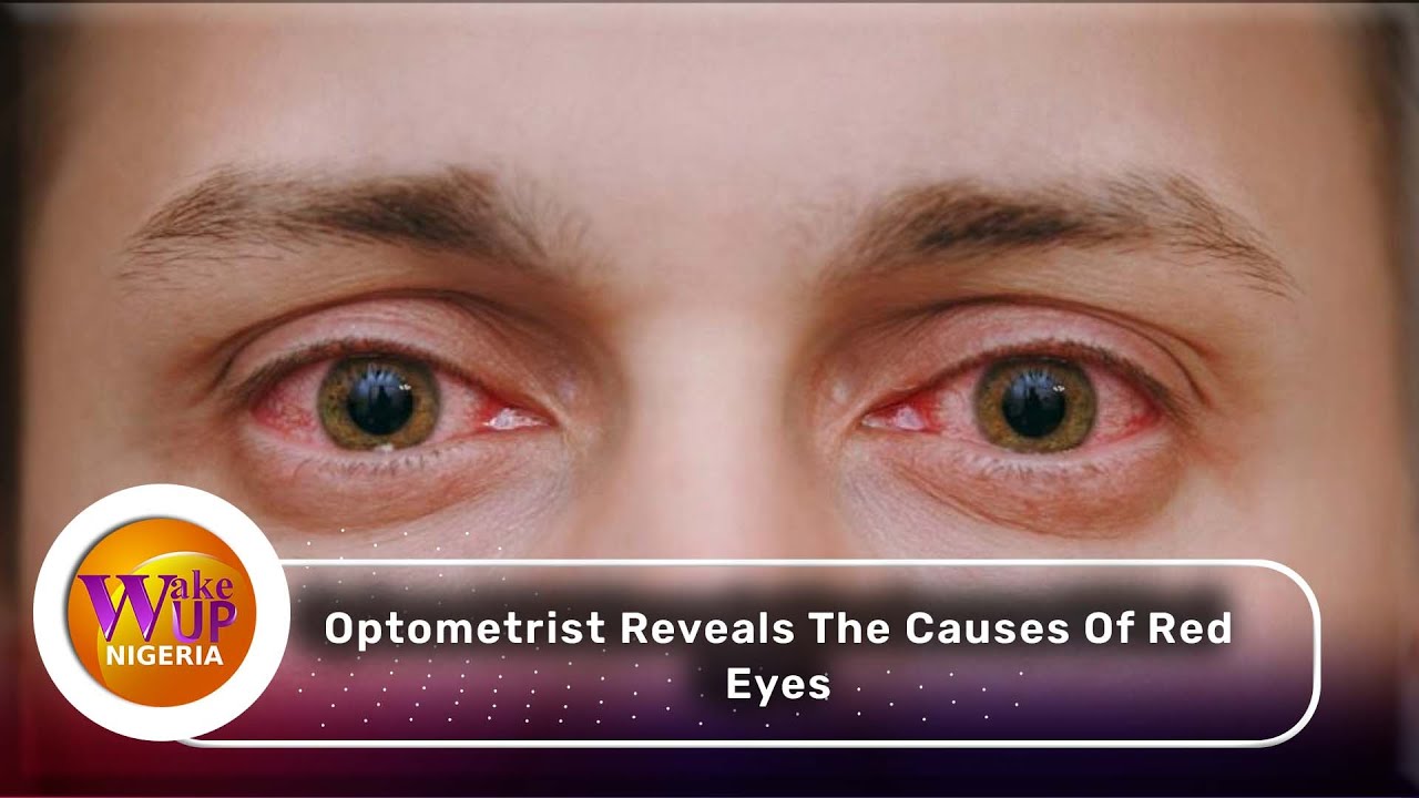 (VIDEO) See what Causes RED EYES! 😱